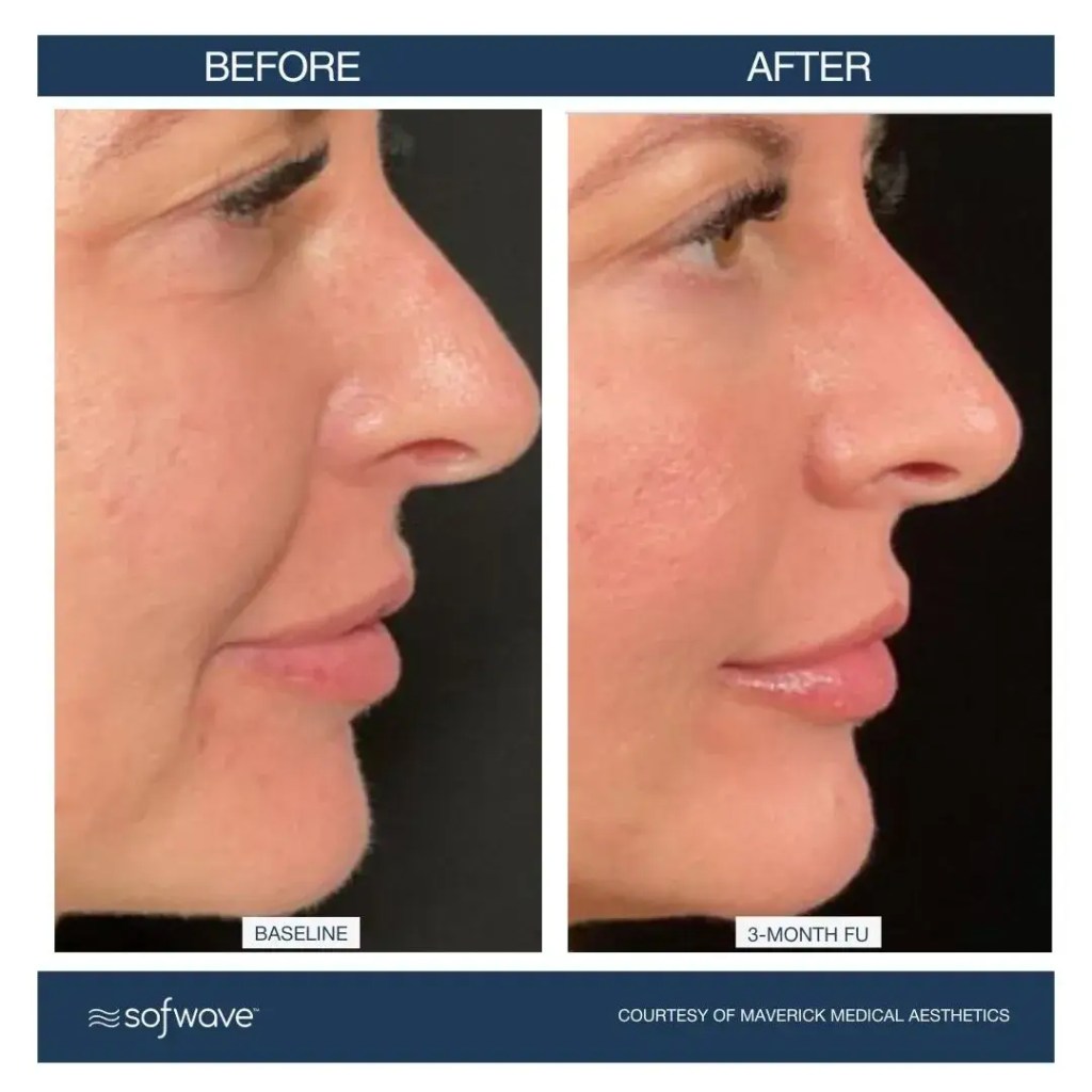 Sofwave Facial Treatments in Fayetteville, AR