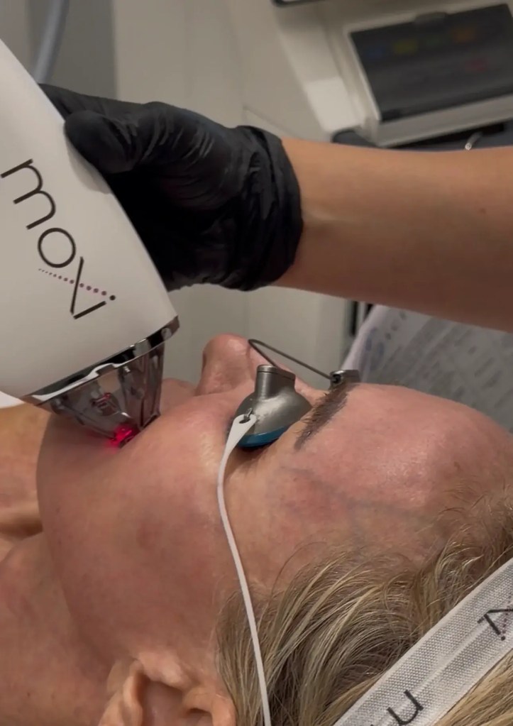MOXI laser treatment at Rejuvenated Med Spa in Fayetteville, AR